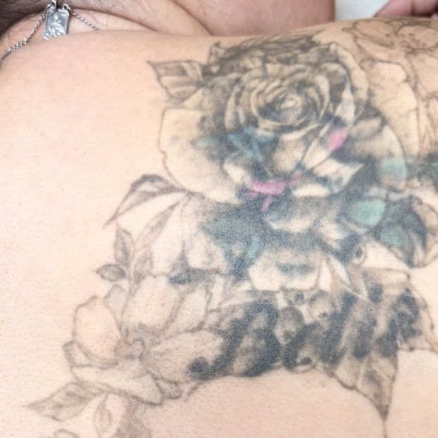 Mesma tatuagem após duas sessões de remoção, com o traço bem mais claro